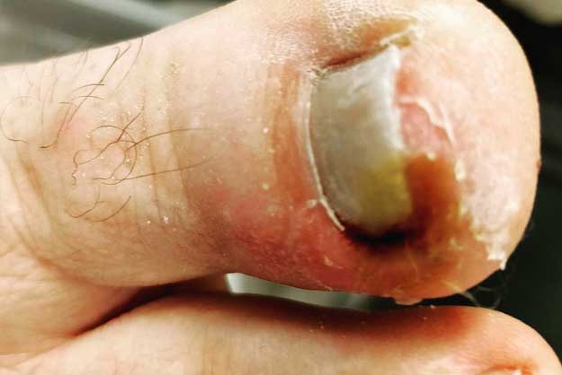 Ingrown Toenail Treatment - Skin Surgery Clinic